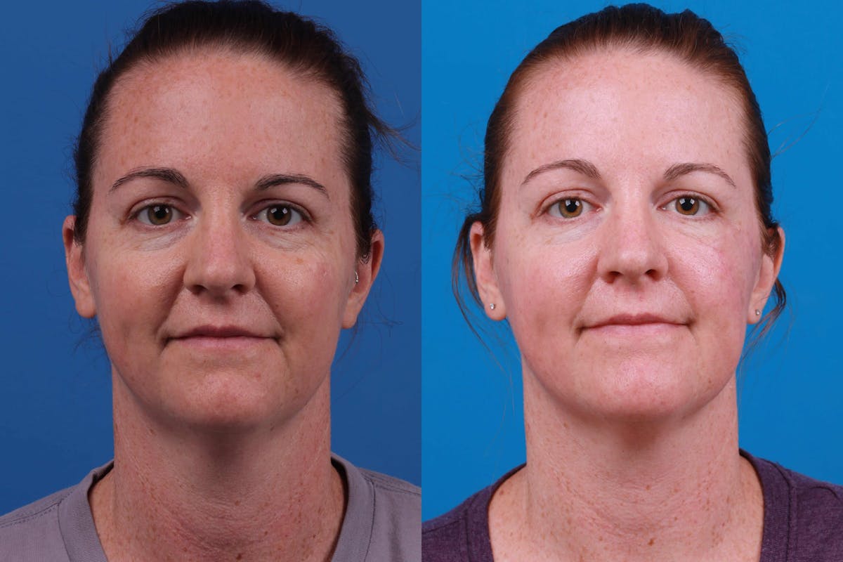 Mohs Surgery and Skin Cancer Before & After Gallery - Patient 122406447 - Image 1