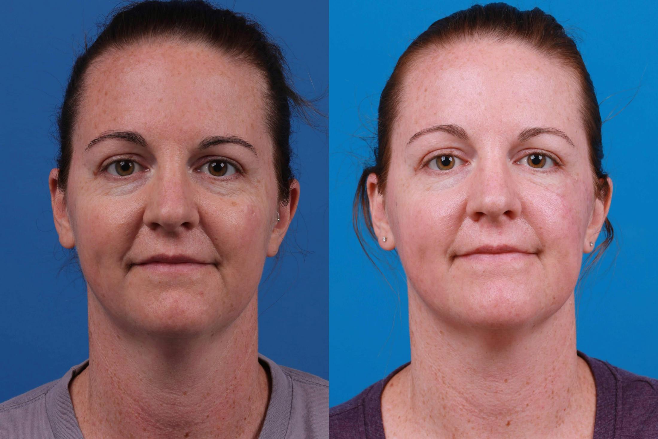 Mohs Surgery and Skin Cancer Before & After Gallery - Patient 122406447 - Image 1
