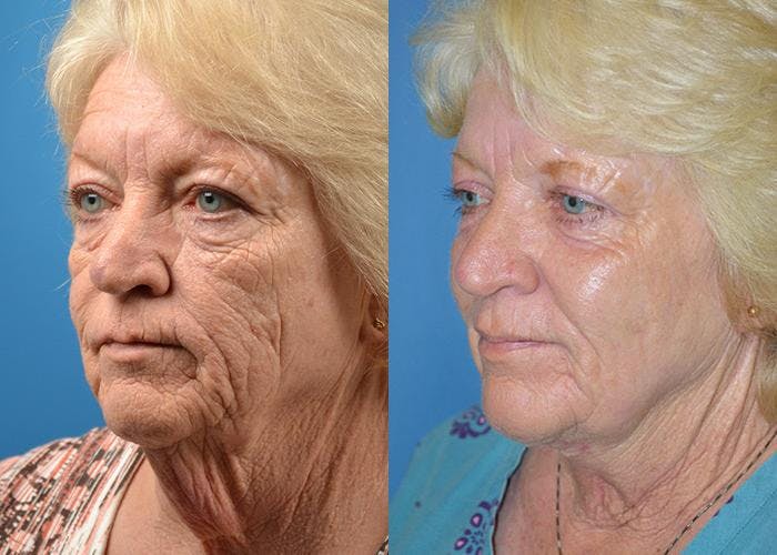 Profile Neck Lift Before & After Gallery - Patient 122406444 - Image 4