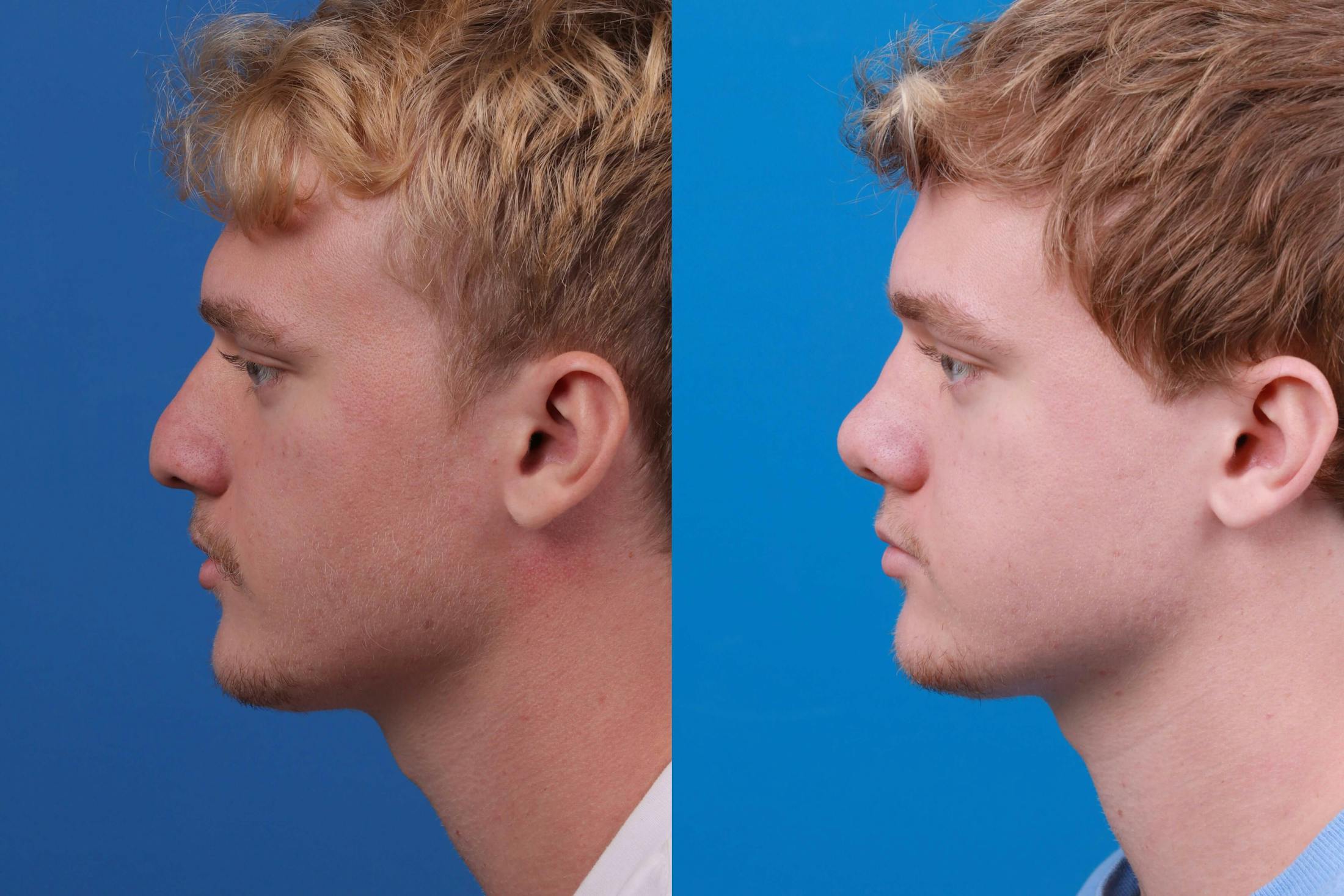 Male Rhinoplasty Before & After Gallery - Patient 122406445 - Image 2