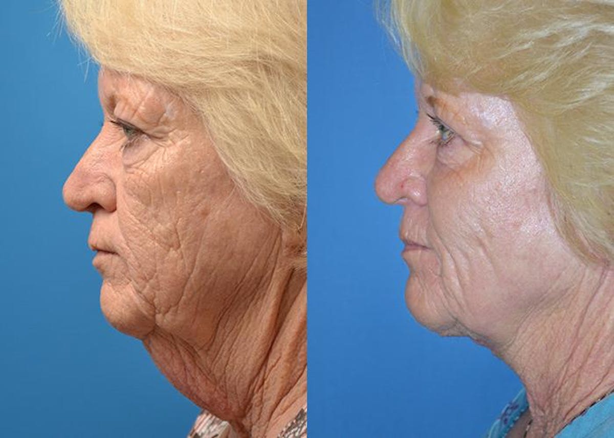 Profile Neck Lift Before & After Gallery - Patient 122406444 - Image 5