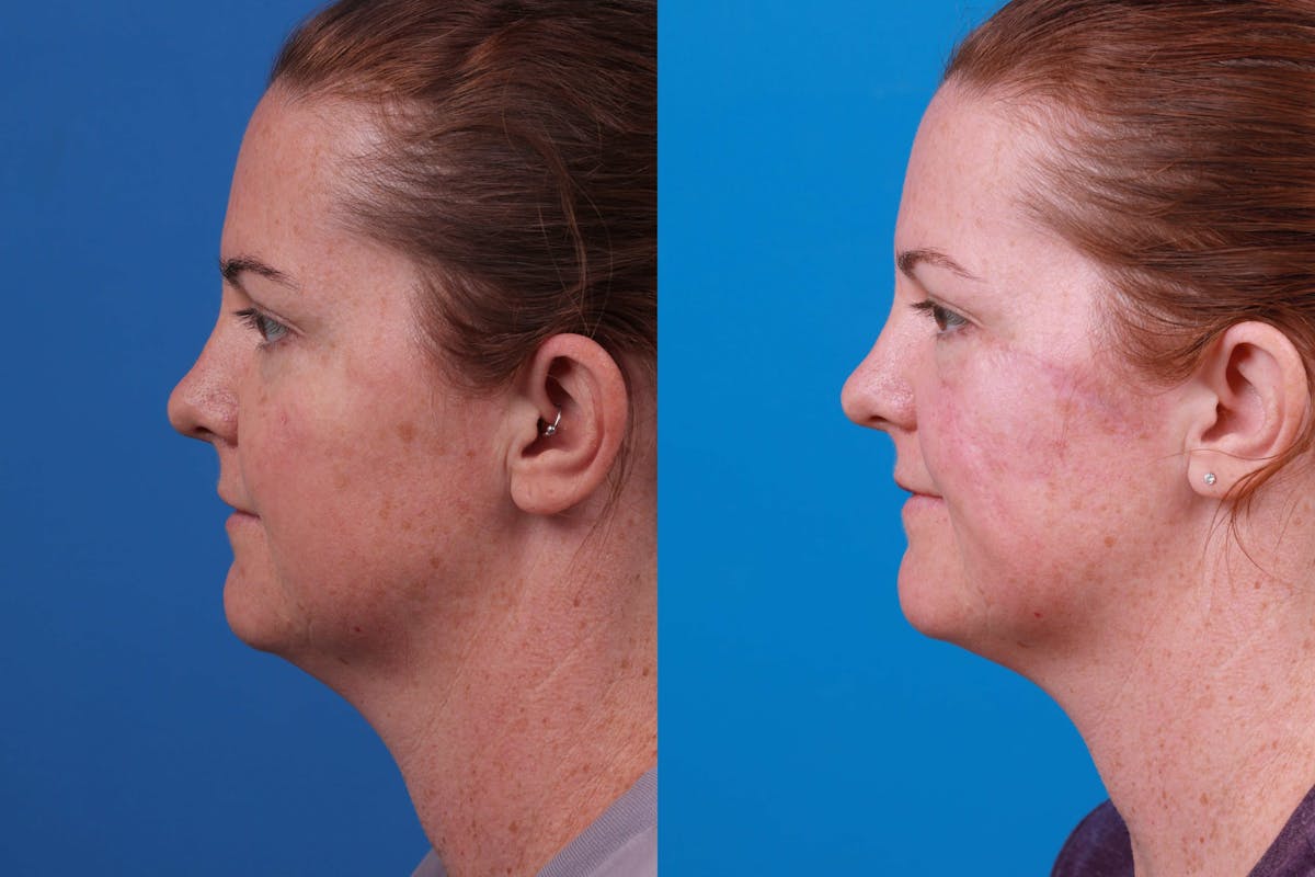 Mohs Surgery and Skin Cancer Before & After Gallery - Patient 122406447 - Image 2