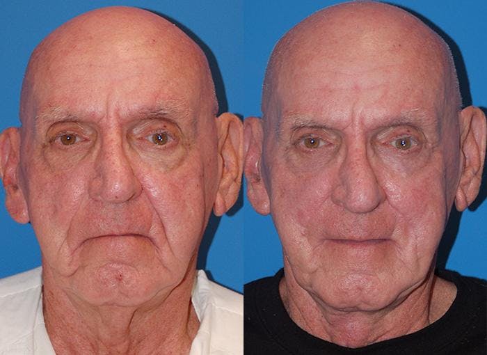 Profile Neck Lift Before & After Gallery - Patient 122406446 - Image 1