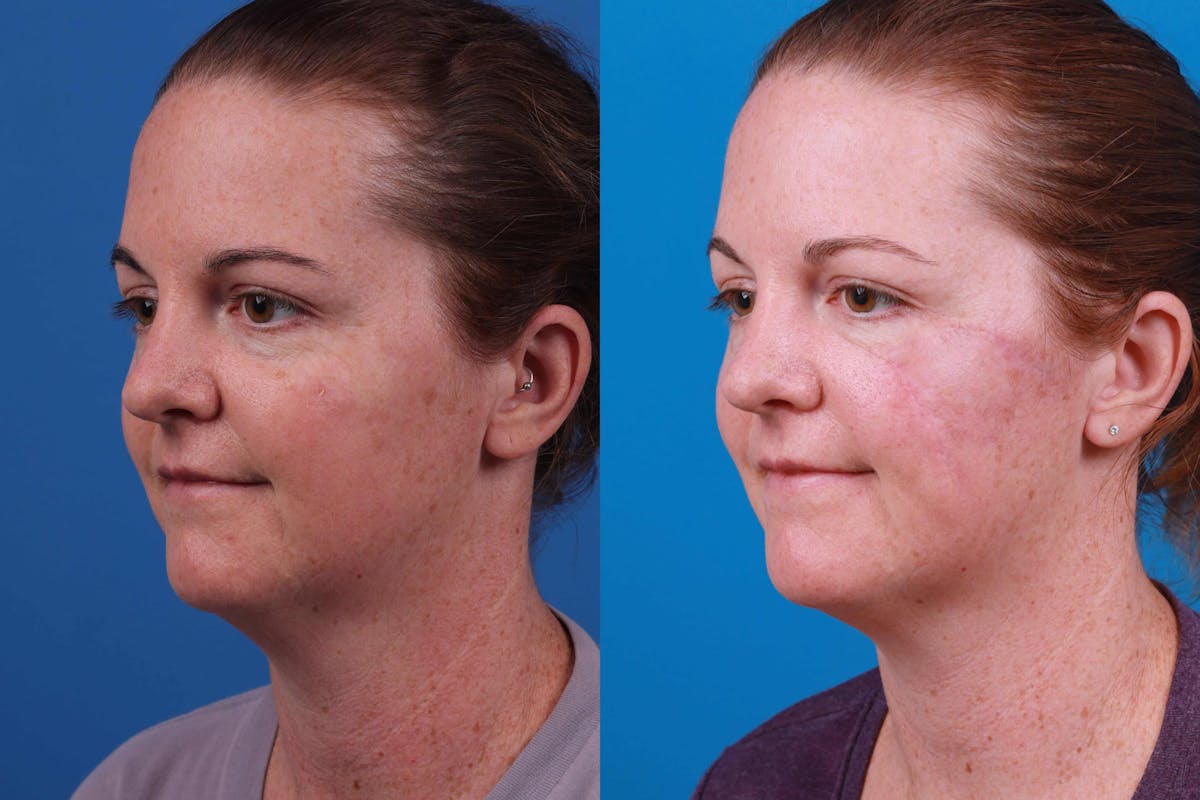 Mohs Surgery and Skin Cancer Before & After Gallery - Patient 122406447 - Image 3