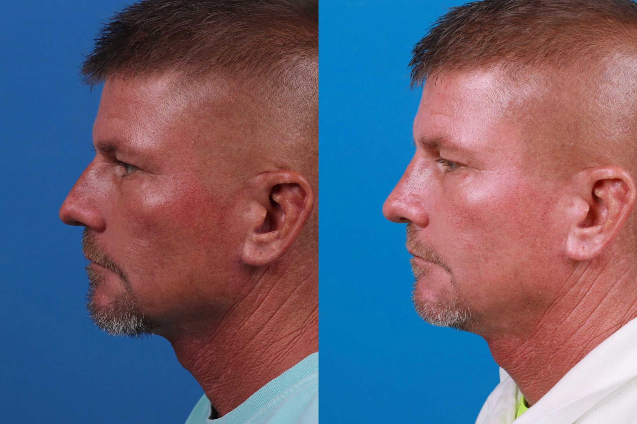 Male Rhinoplasty Before & After Gallery - Patient 122406448 - Image 2