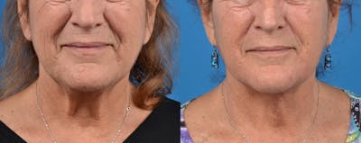 Profile Neck Lift Before & After Gallery - Patient 122406449 - Image 1