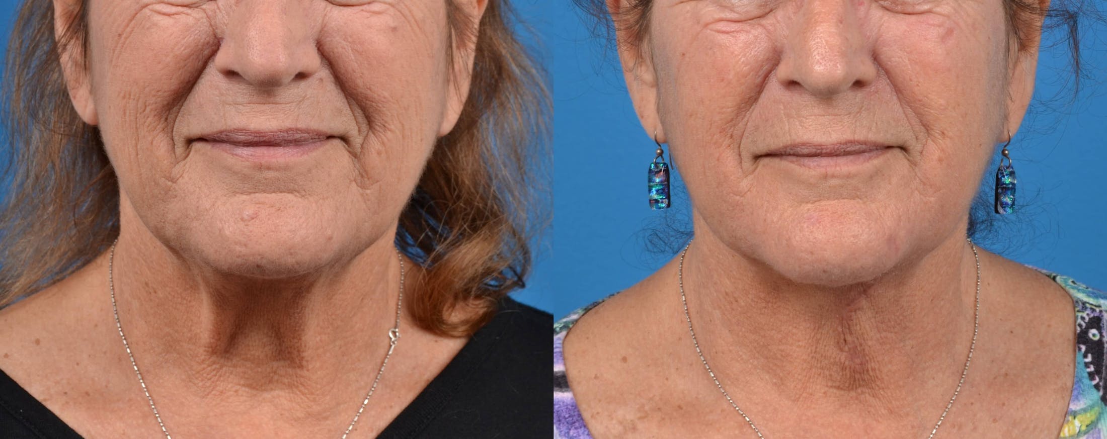 Profile Neck Lift Before & After Gallery - Patient 122406449 - Image 1