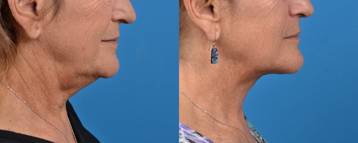 Profile Neck Lift Before & After Gallery - Patient 122406449 - Image 2