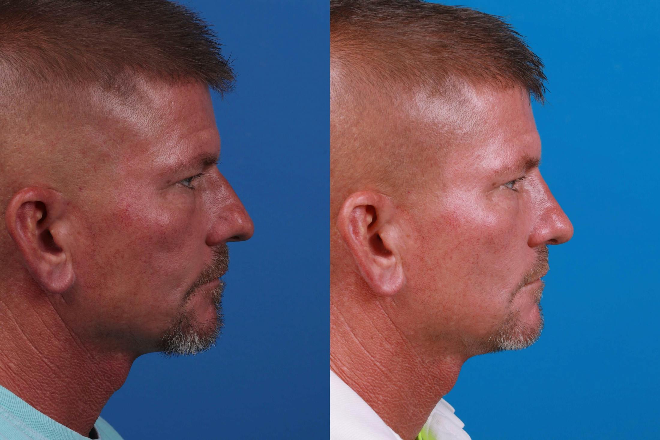Male Rhinoplasty Before & After Gallery - Patient 122406448 - Image 3