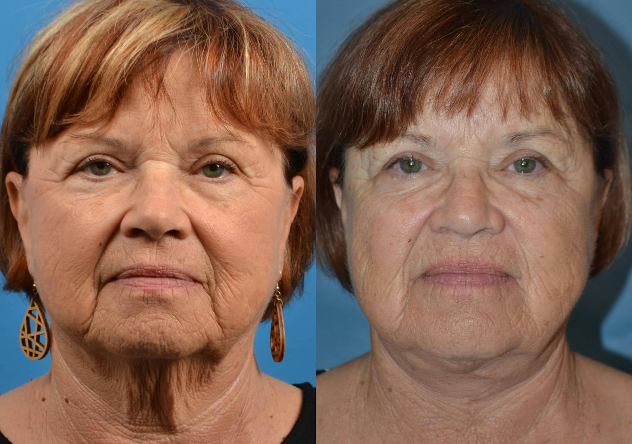 Profile Neck Lift Before & After Gallery - Patient 122406451 - Image 1