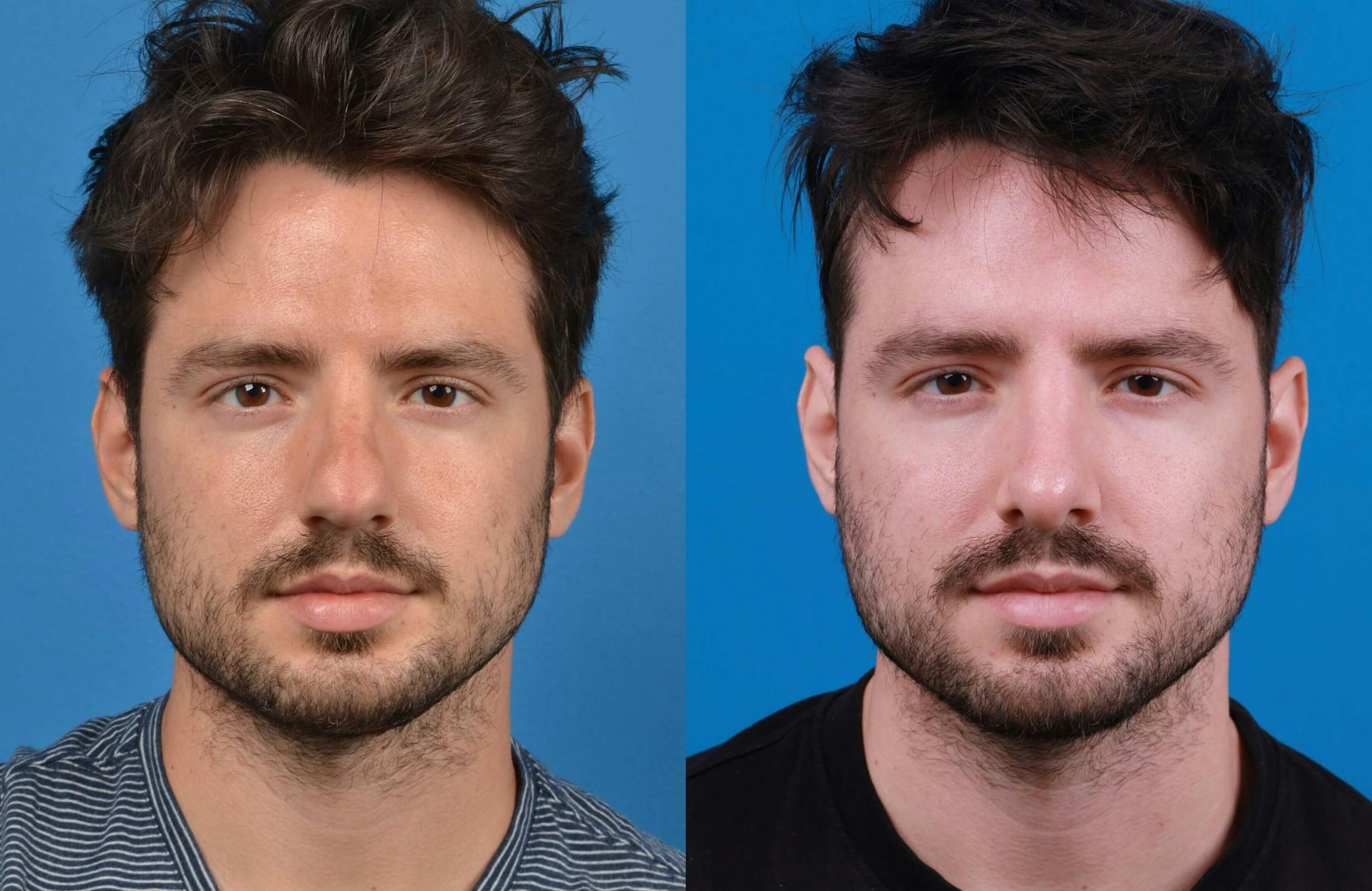 Male Rhinoplasty Before & After Gallery - Patient 122406450 - Image 1