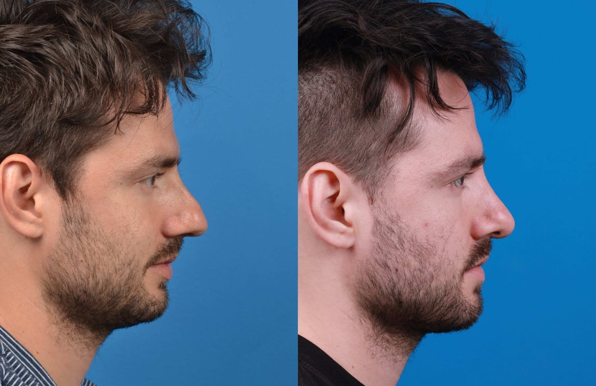 Male Rhinoplasty Before & After Gallery - Patient 122406450 - Image 2