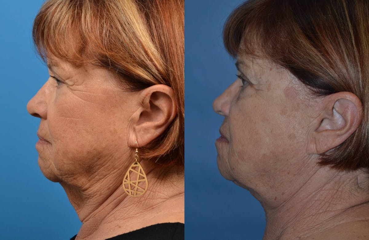 Profile Neck Lift Before & After Gallery - Patient 122406451 - Image 2