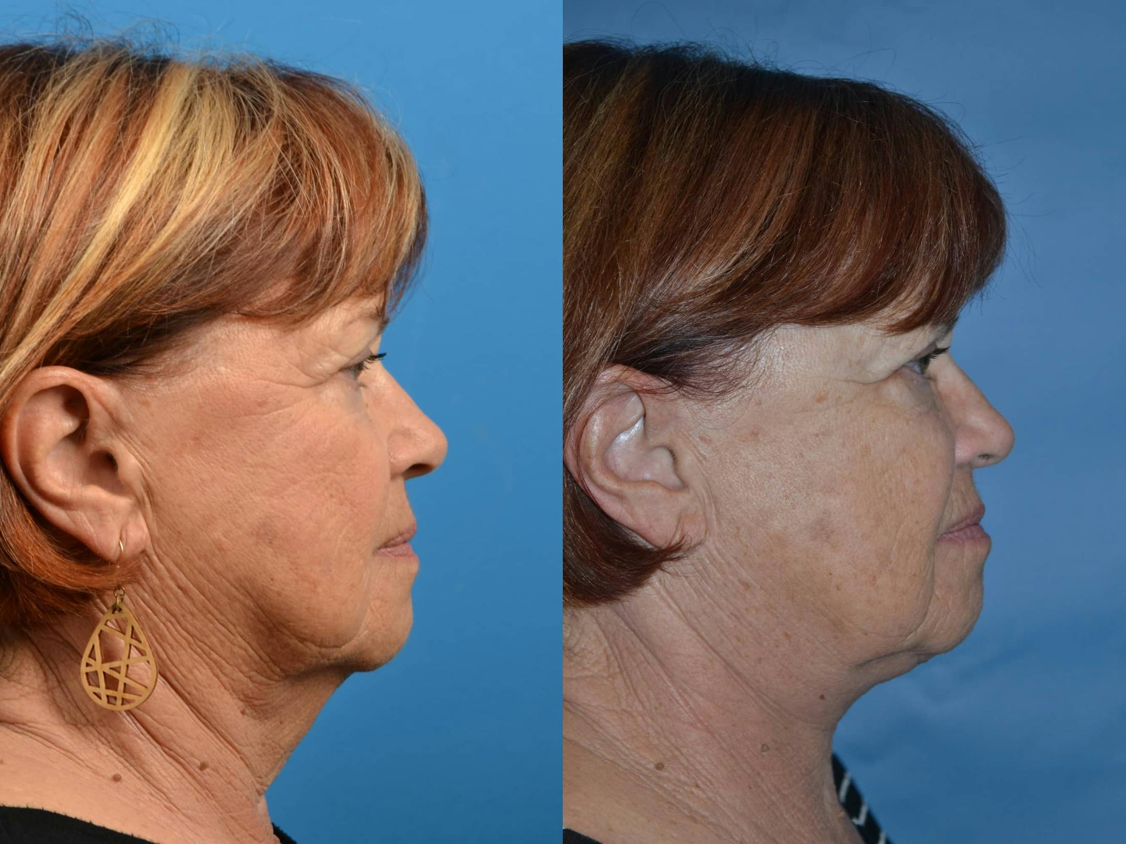 Profile Neck Lift Before & After Gallery - Patient 122406451 - Image 3