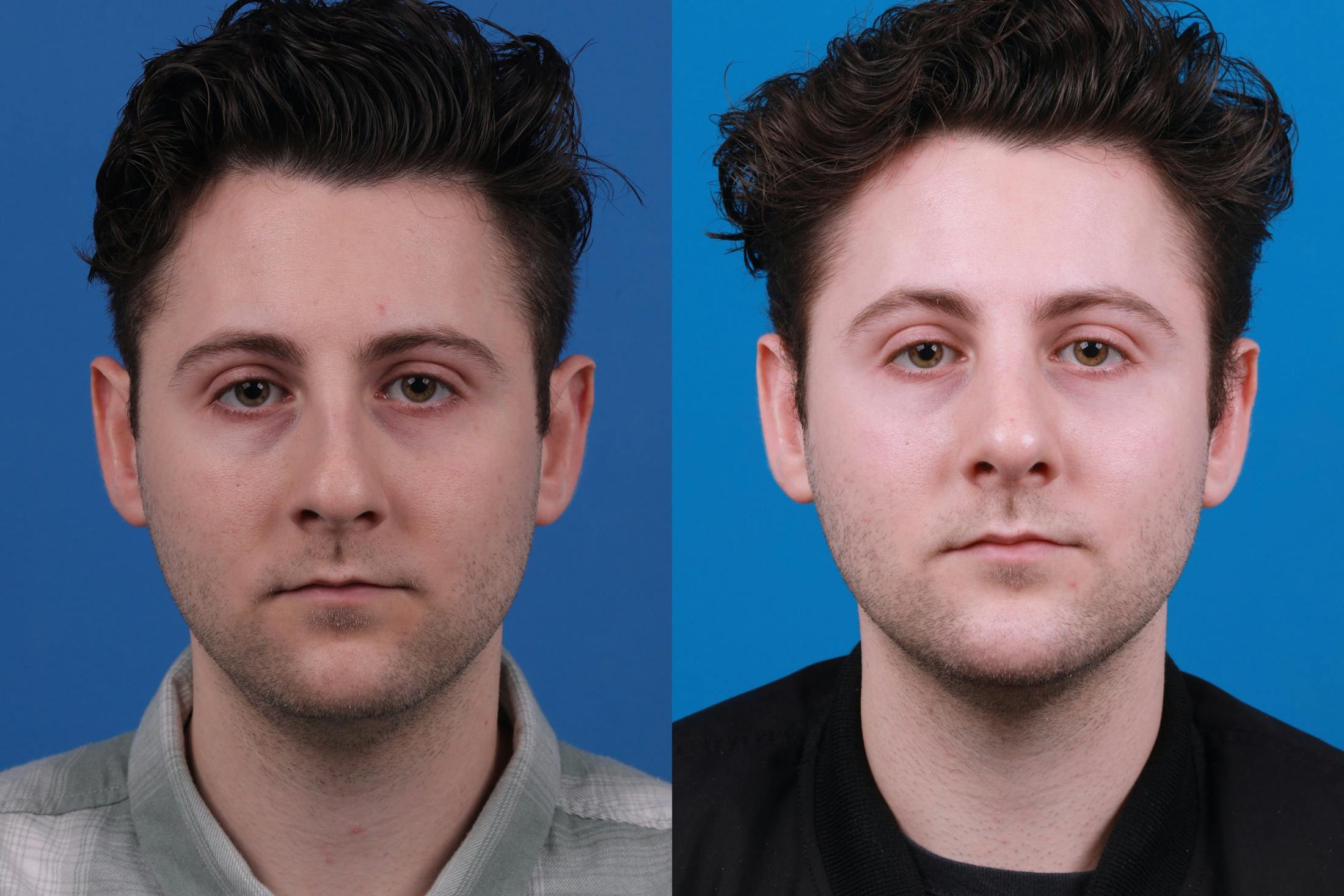 Rhinoplasty Before & After Gallery - Patient 142763003 - Image 1