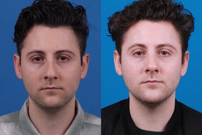 Male Rhinoplasty Before & After Gallery - Patient 122406459 - Image 1