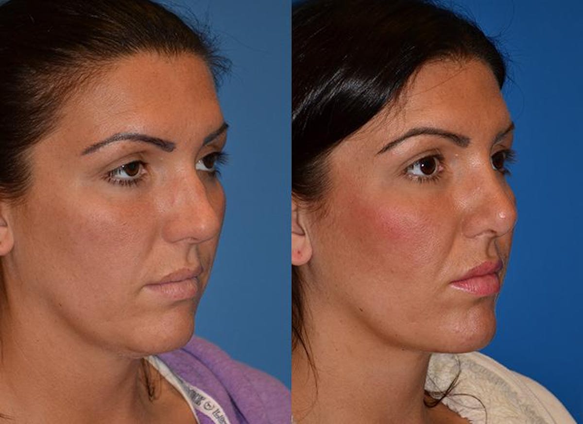 Laser Assisted Weekend Neck Lift Before & After Gallery - Patient 122406453 - Image 1