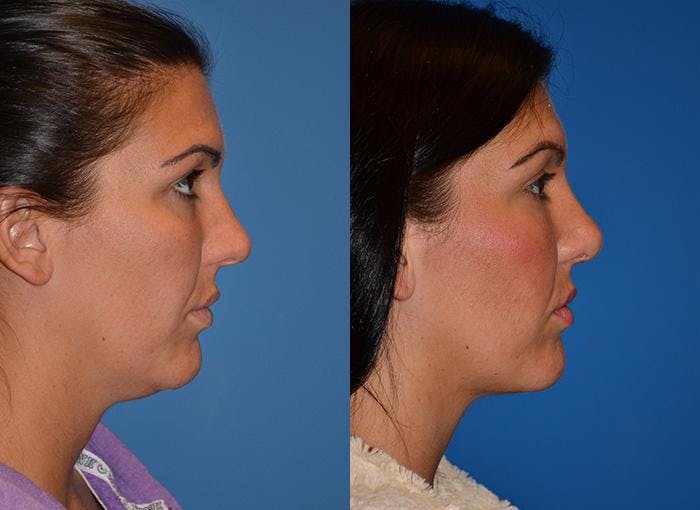 Laser Assisted Weekend Neck Lift Gallery - Patient 122406453 - Image 2