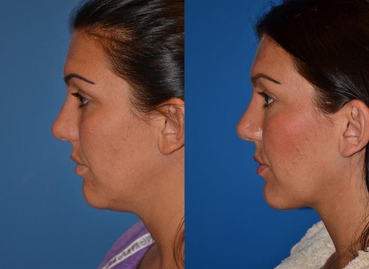 Laser Assisted Weekend Neck Lift Before & After Gallery - Patient 122406453 - Image 3