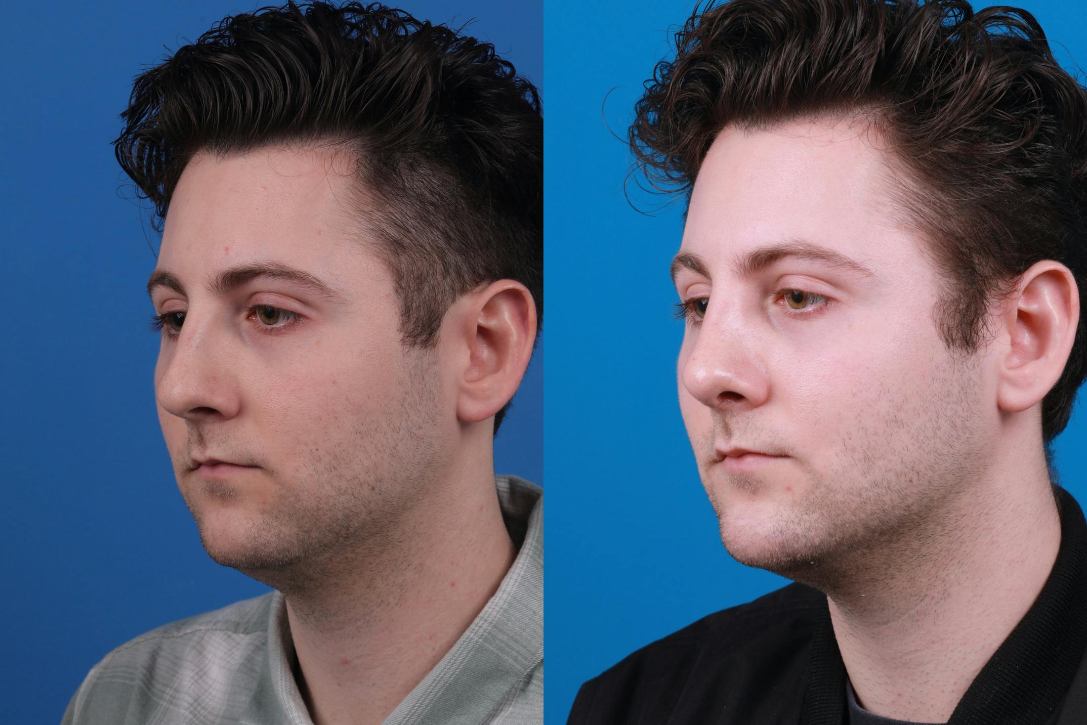 Rhinoplasty Before & After Gallery - Patient 142763003 - Image 3