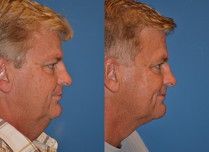 Laser Assisted Weekend Neck Lift Before & After Gallery - Patient 122406454 - Image 2