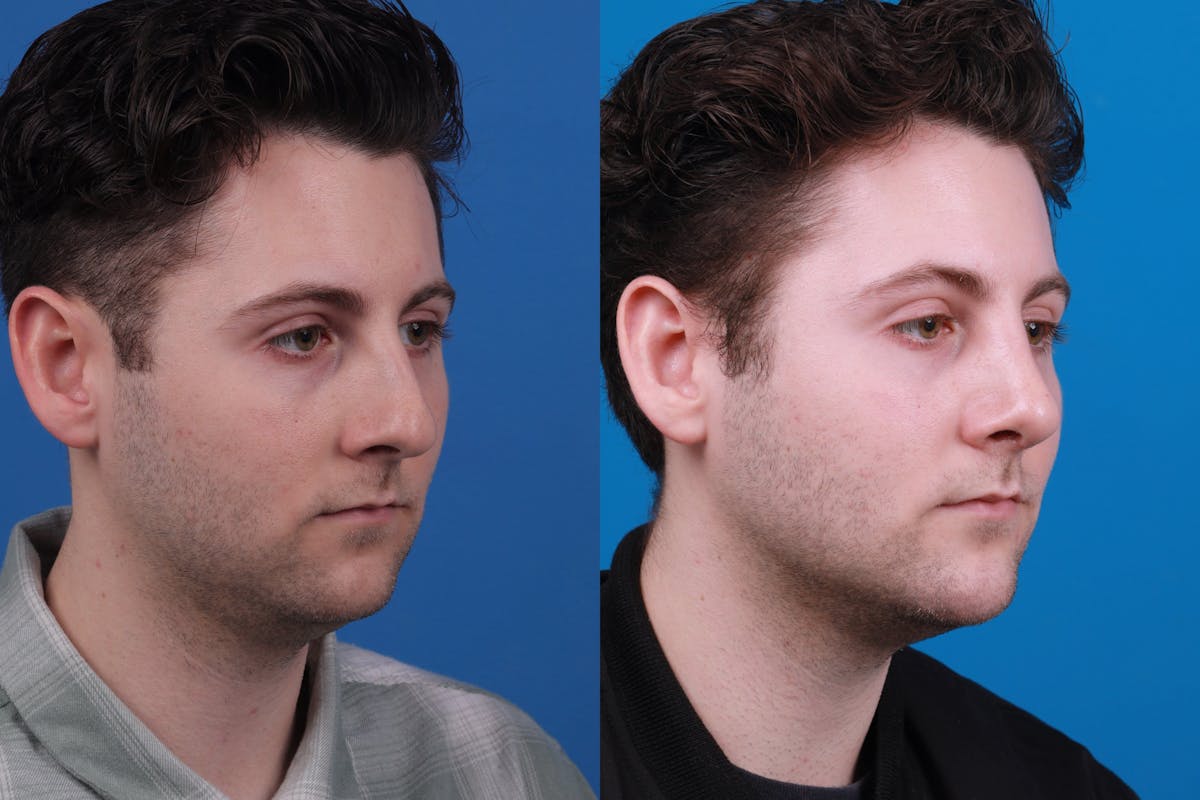 Male Rhinoplasty Before & After Gallery - Patient 122406459 - Image 4