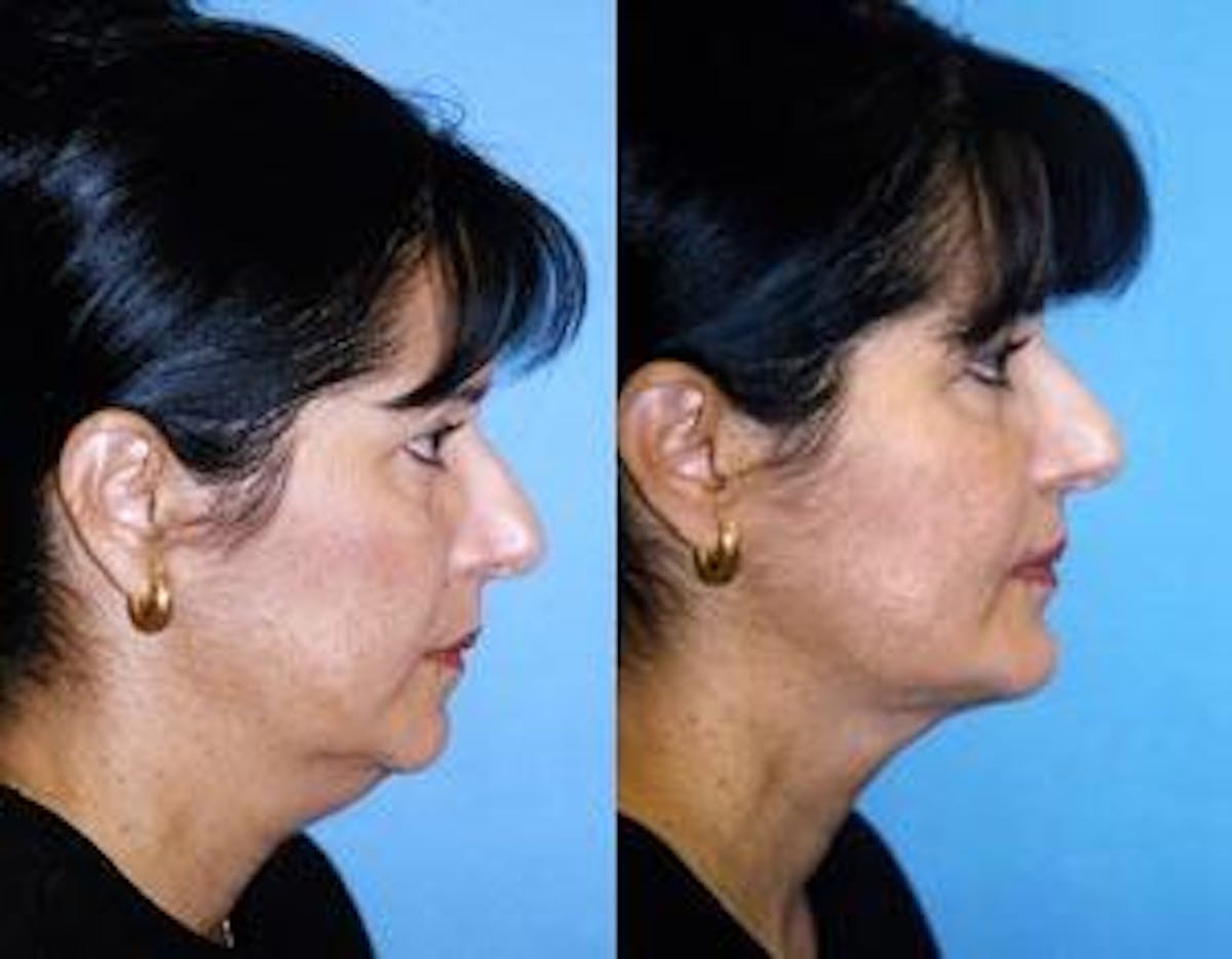 Laser Assisted Weekend Neck Lift Before & After Gallery - Patient 122406455 - Image 1