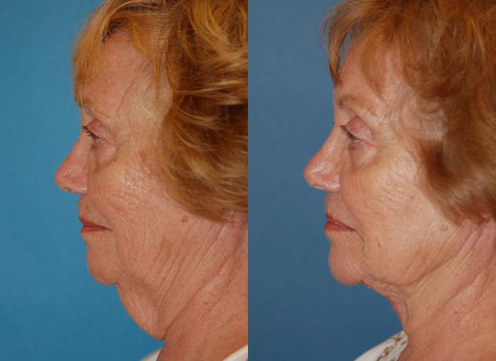 Laser Assisted Weekend Neck Lift Before & After Gallery - Patient 122406458 - Image 1