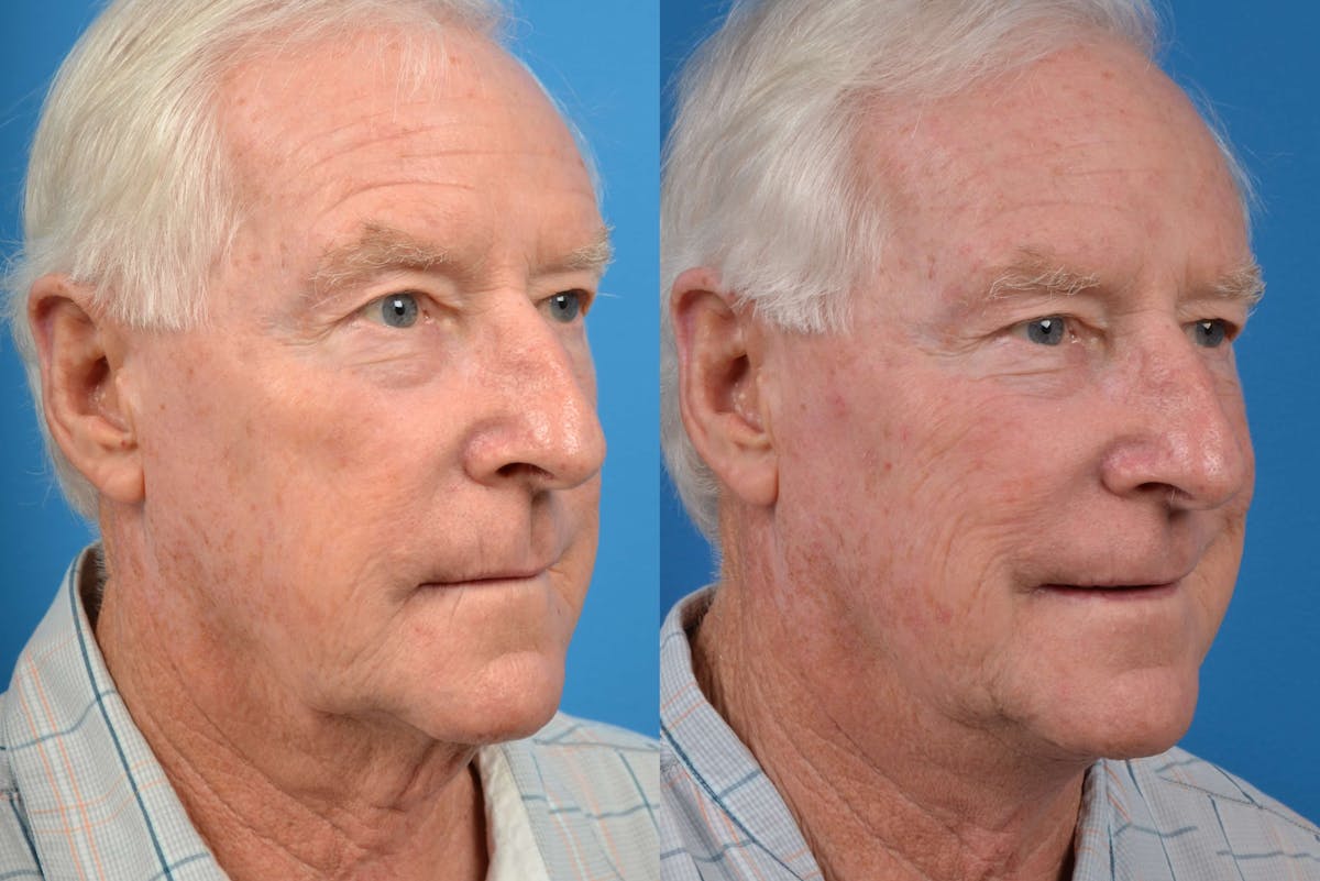 Profile Neck Lift Before & After Gallery - Patient 122406462 - Image 3