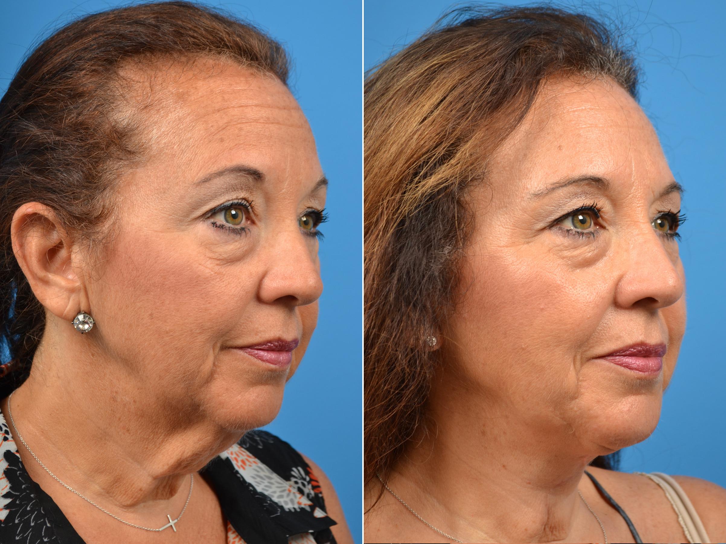 Patient 122406460 Laser Assisted Weekend Neck Lift Before And After
