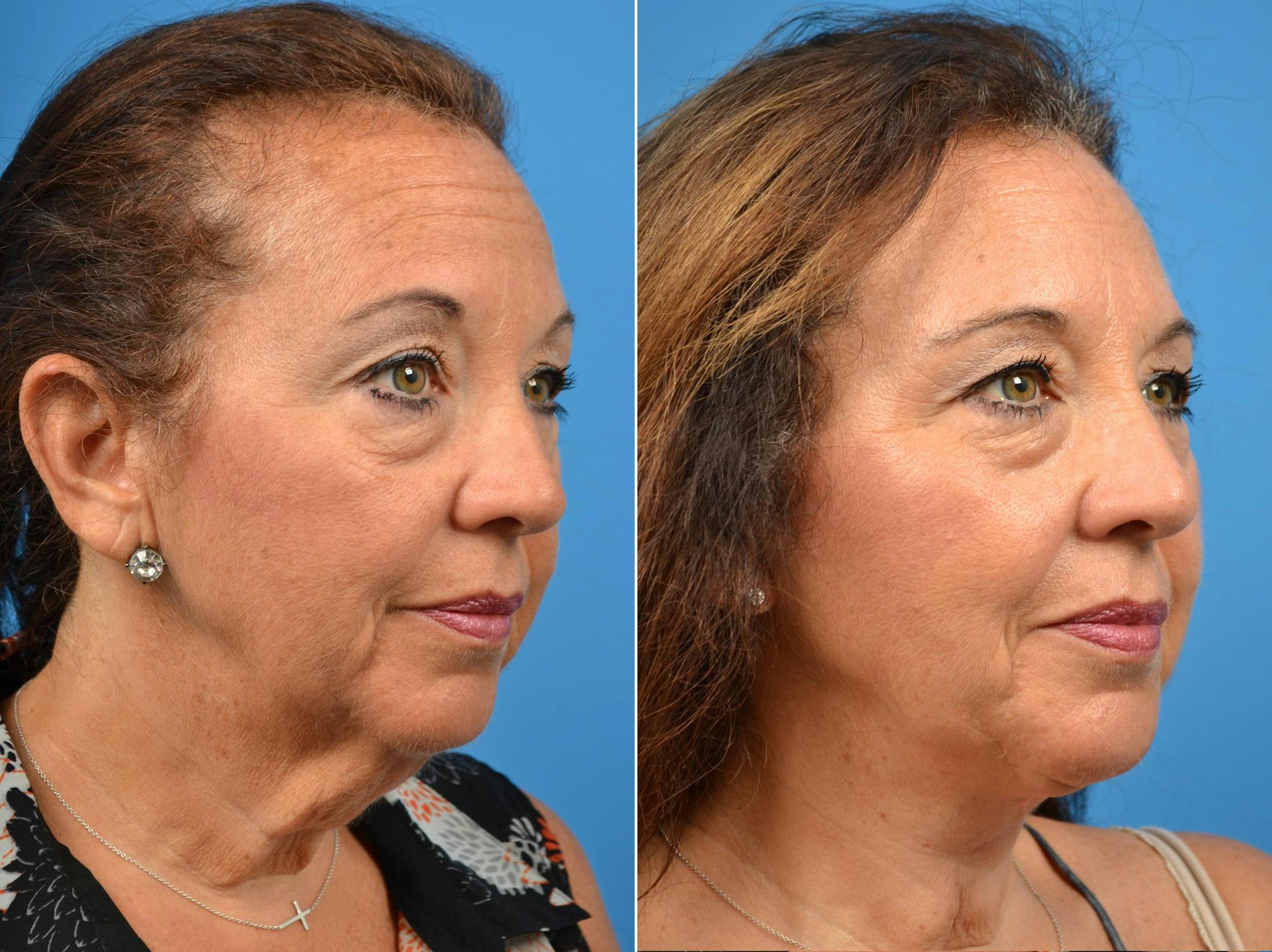Laser Assisted Weekend Neck Lift Before & After Gallery - Patient 122406460 - Image 1