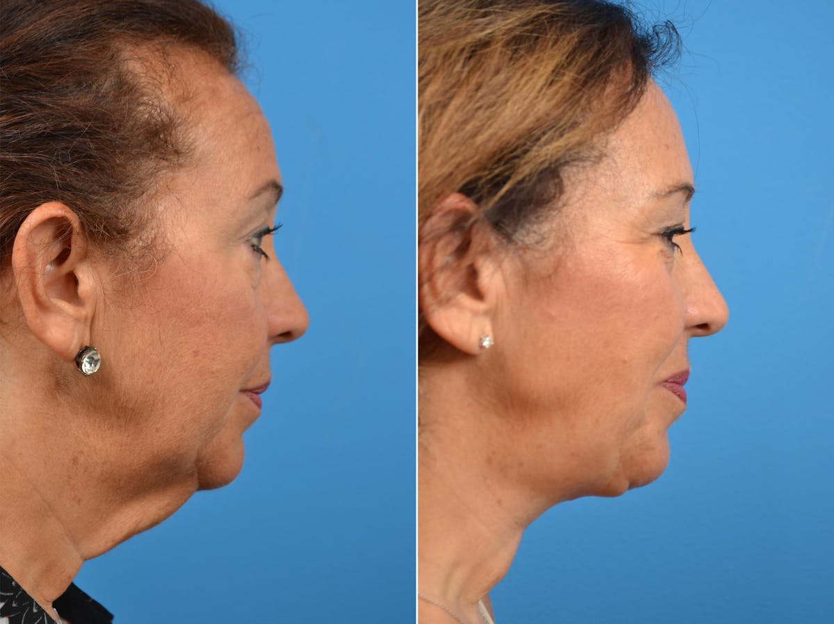 Laser Assisted Weekend Neck Lift Before & After Gallery - Patient 122406460 - Image 2