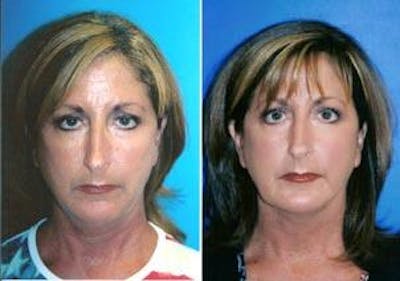Laser Assisted Weekend Neck Lift Before & After Gallery - Patient 122406461 - Image 1