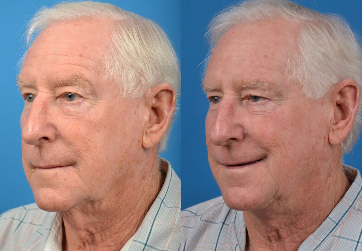 Profile Neck Lift Before & After Gallery - Patient 122406462 - Image 4