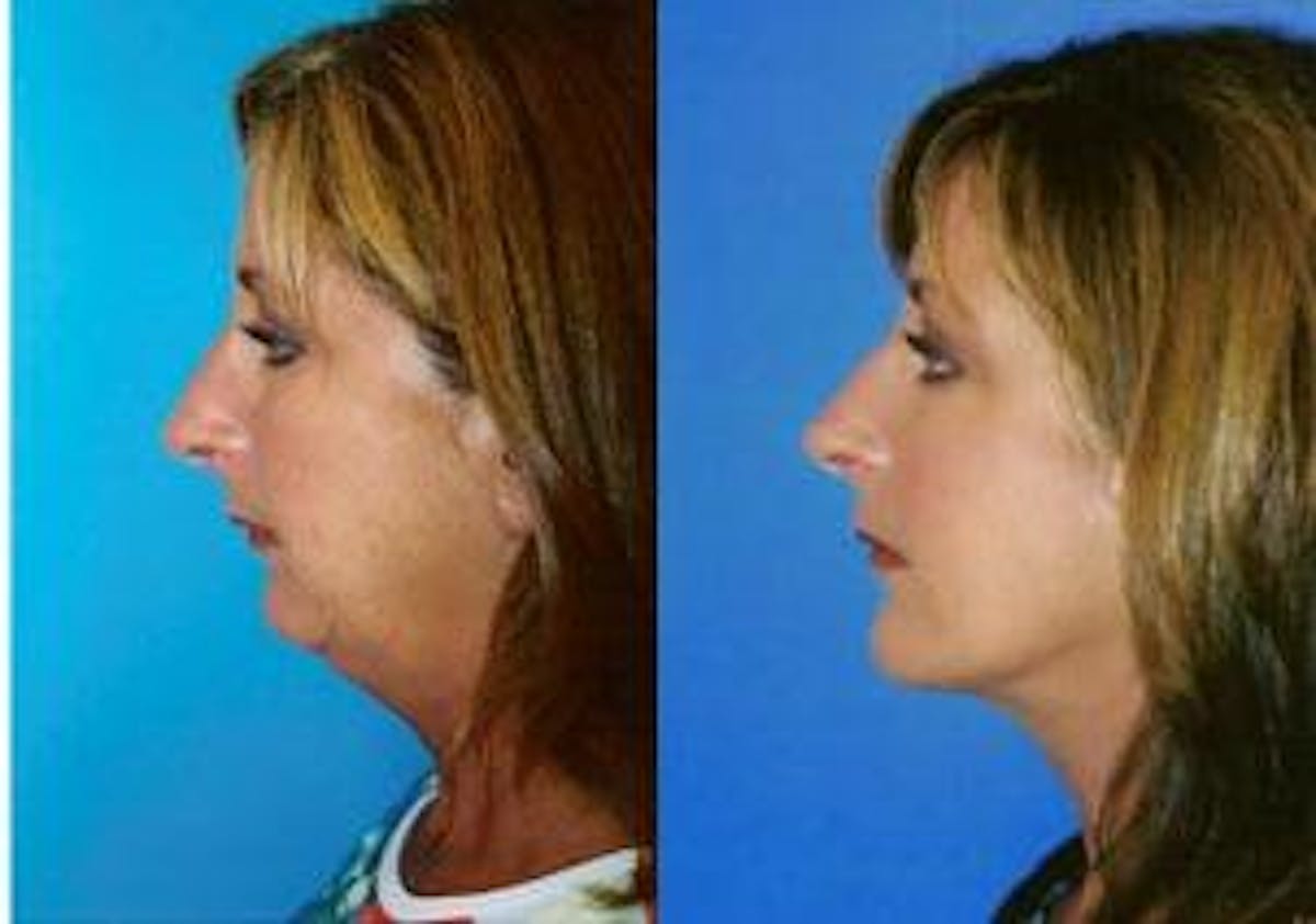 Laser Assisted Weekend Neck Lift Before & After Gallery - Patient 122406461 - Image 2