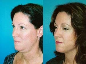 Laser Assisted Weekend Neck Lift Before & After Gallery - Patient 122406463 - Image 1