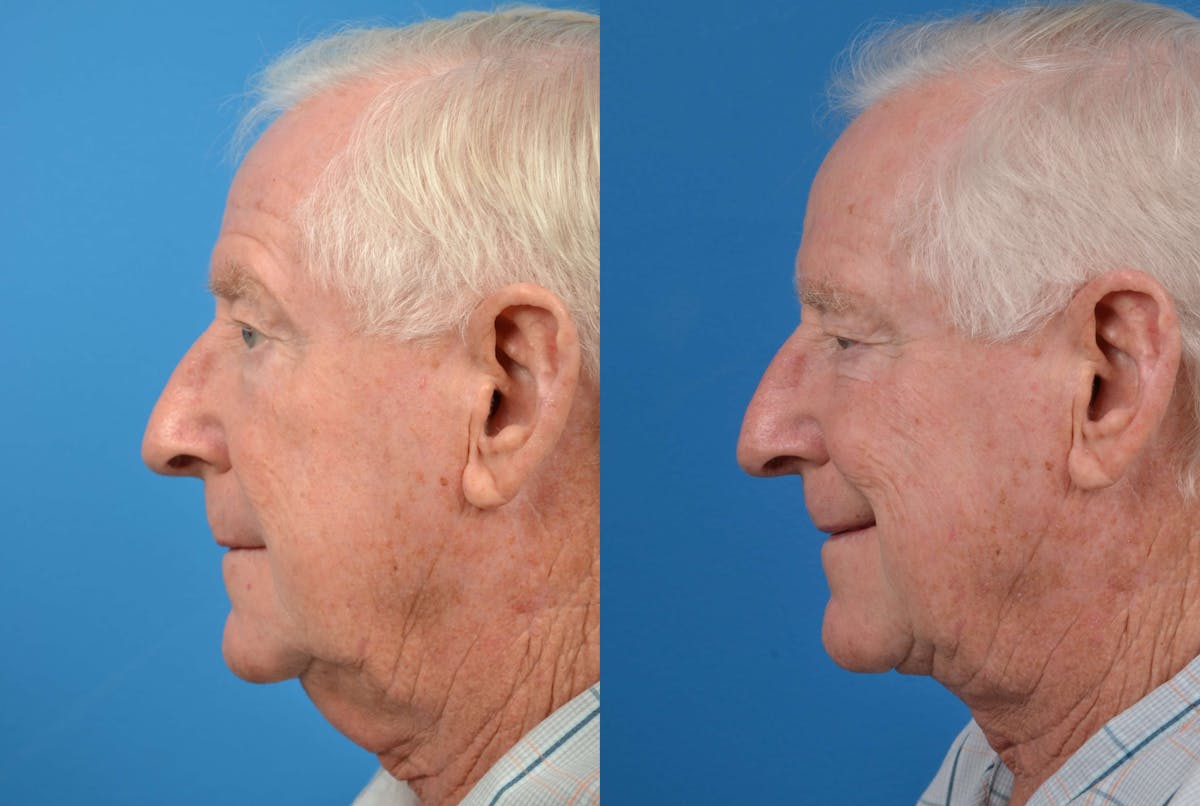 Profile Neck Lift Before & After Gallery - Patient 122406462 - Image 5
