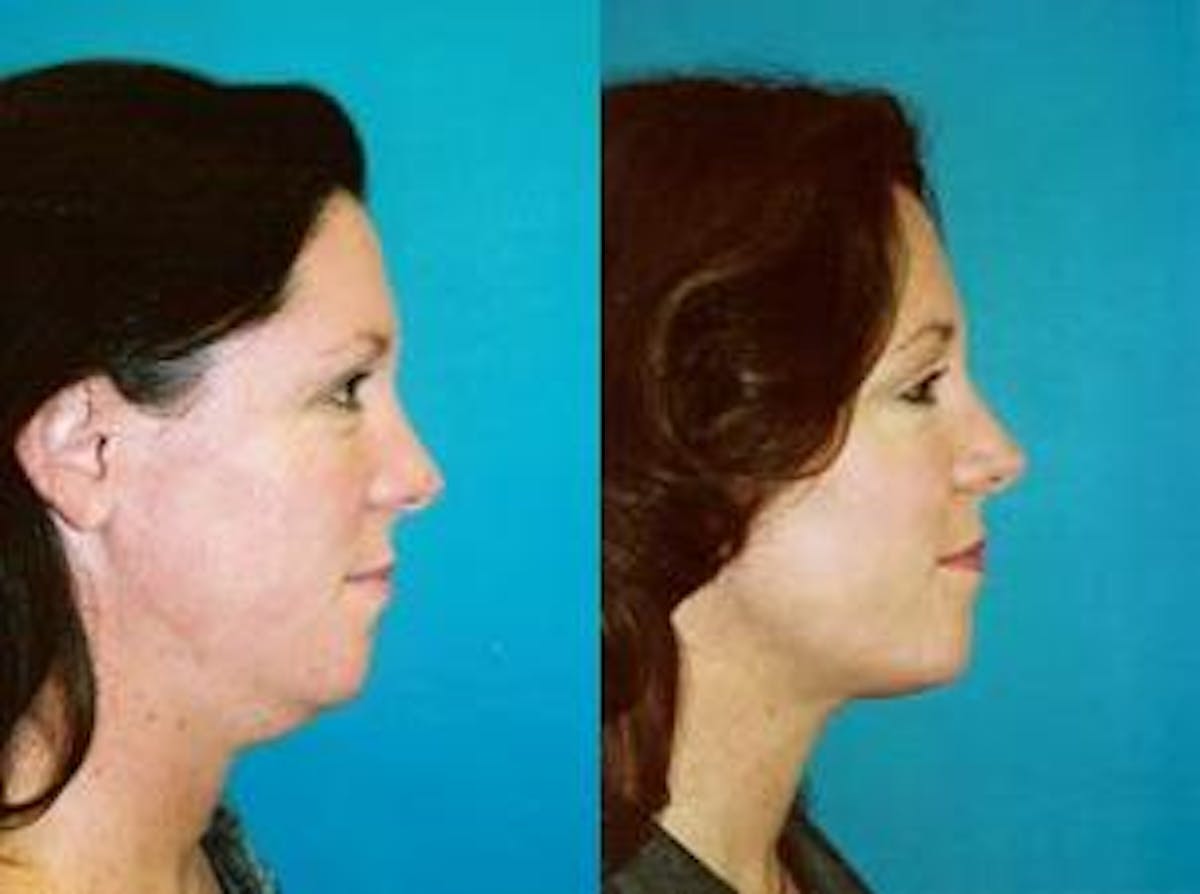 Laser Assisted Weekend Neck Lift Before & After Gallery - Patient 122406463 - Image 2
