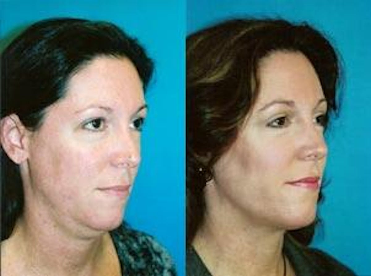Laser Assisted Weekend Neck Lift Before & After Gallery - Patient 122406463 - Image 3
