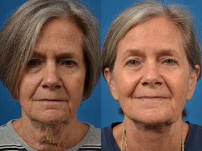 Profile Neck Lift Before & After Gallery - Patient 122406467 - Image 1