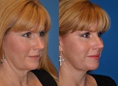 Laser Assisted Weekend Neck Lift Before & After Gallery - Patient 122406464 - Image 1