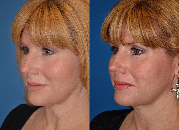 Laser Assisted Weekend Neck Lift Gallery - Patient 122406464 - Image 2
