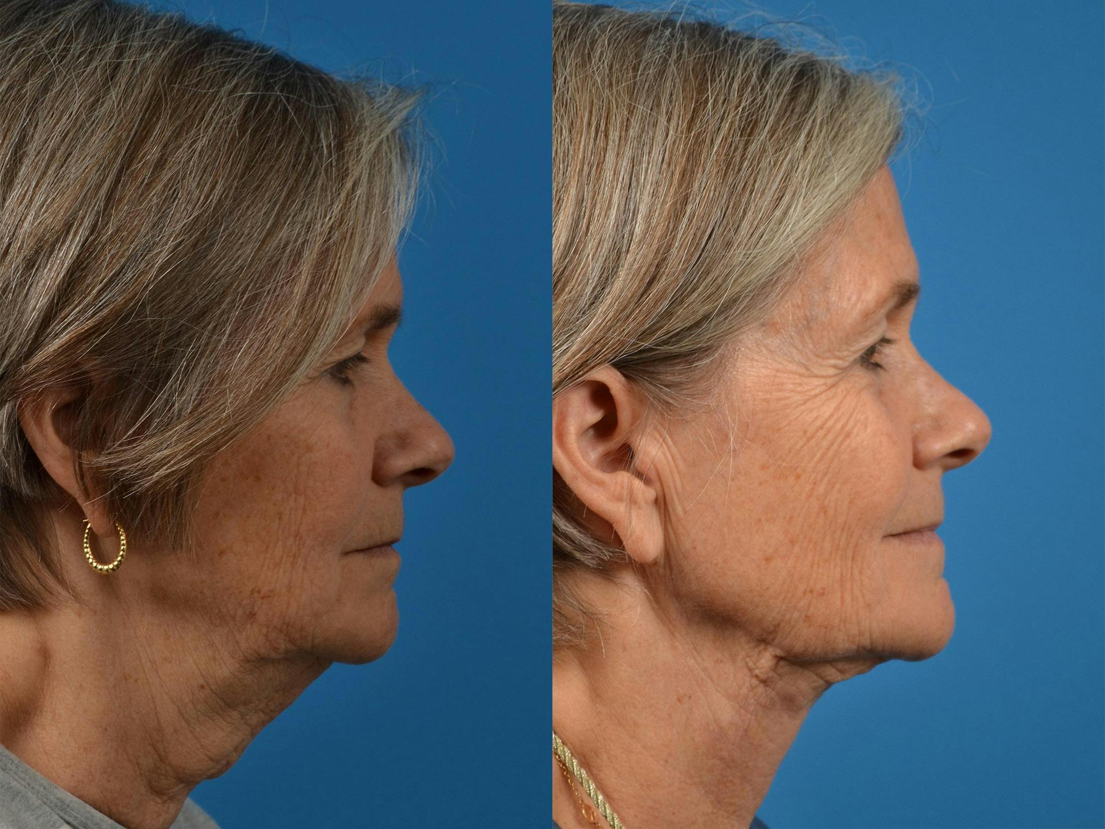 Profile Neck Lift Before & After Gallery - Patient 122406467 - Image 2