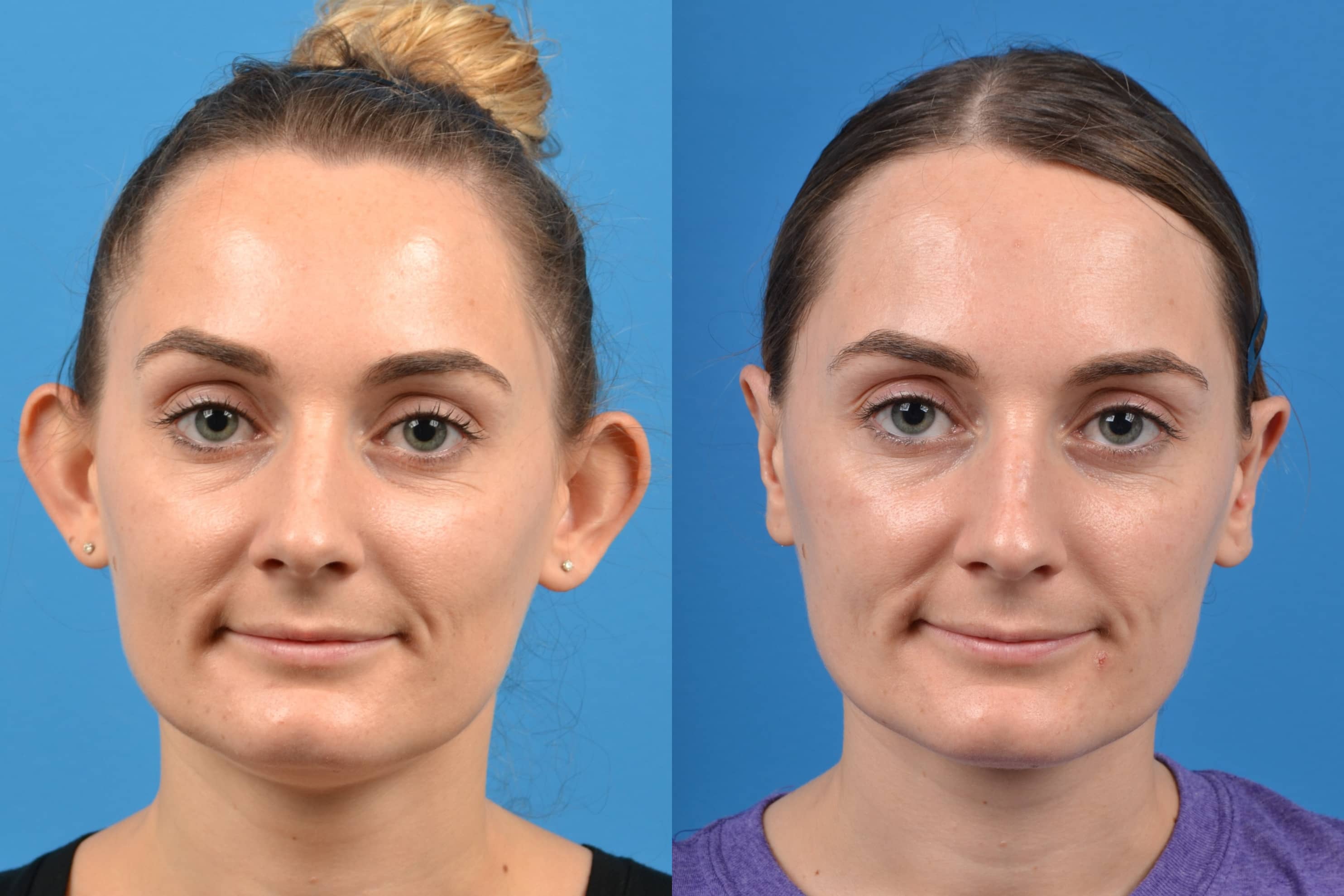 Ear Surgery Before & After Gallery - Patient 122406468 - Image 1