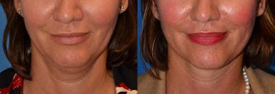 Laser Assisted Weekend Neck Lift Before & After Gallery - Patient 122406465 - Image 1