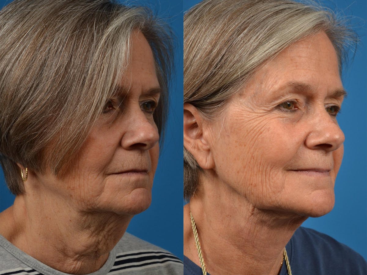 Profile Neck Lift Before & After Gallery - Patient 122406467 - Image 3