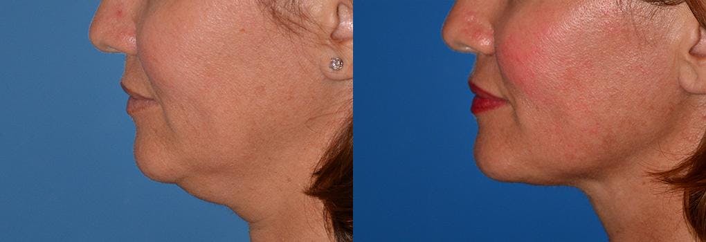 Laser Assisted Weekend Neck Lift Before & After Gallery - Patient 122406465 - Image 2