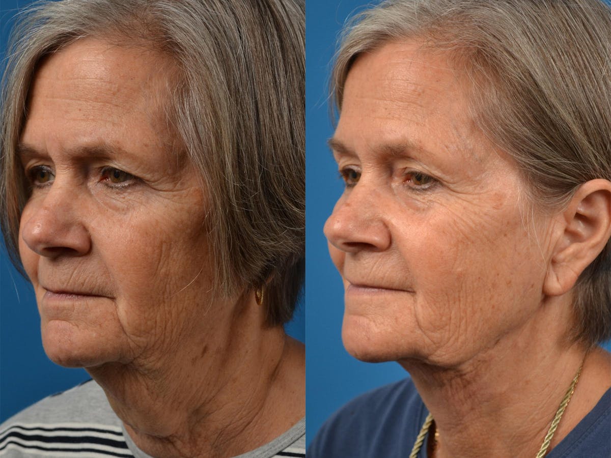 Profile Neck Lift Before & After Gallery - Patient 122406467 - Image 4