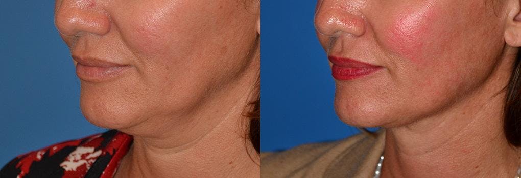 Laser Assisted Weekend Neck Lift Before & After Gallery - Patient 122406465 - Image 3