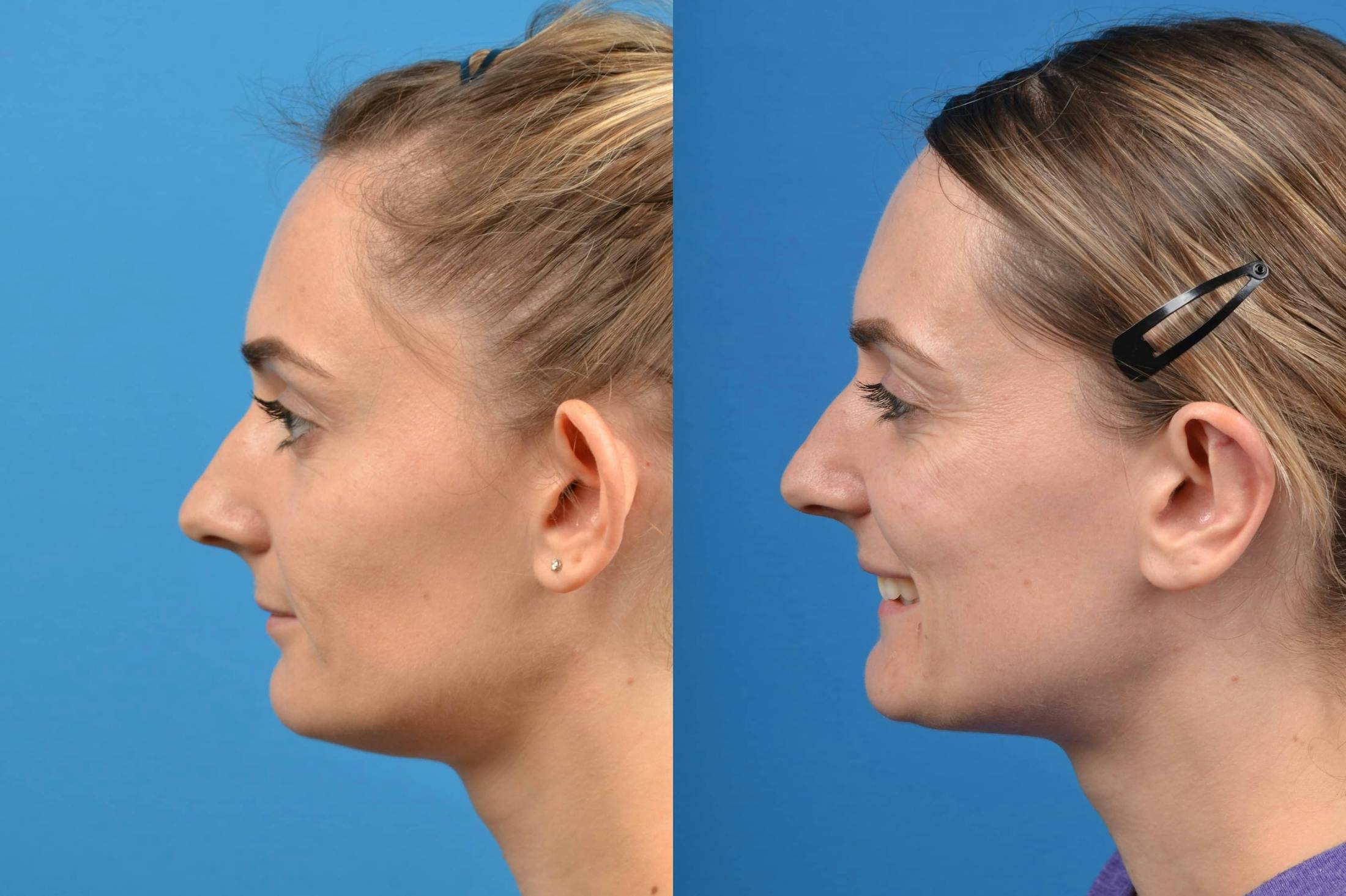 Ear Surgery Before & After Gallery - Patient 122406468 - Image 3